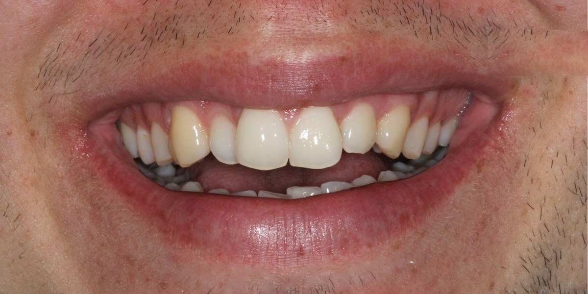 Before Active Aligners treatment, smile, crowded, treated by Dr Marc Sher