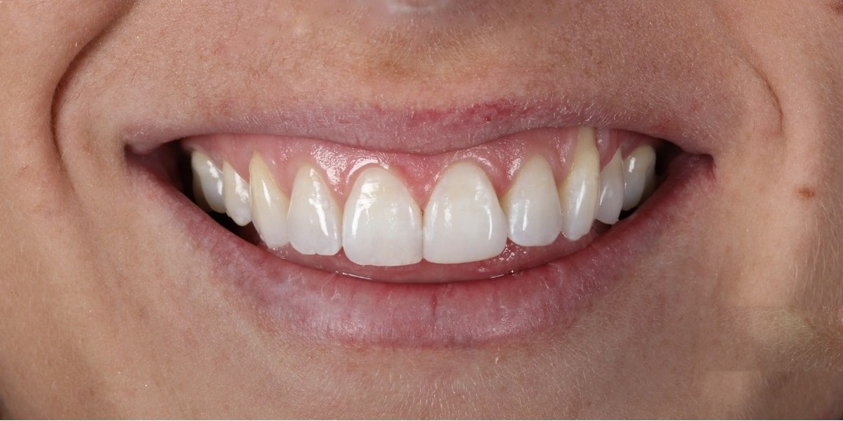 After Active Aligners treatment, smile, treated by Dr Marc Sher