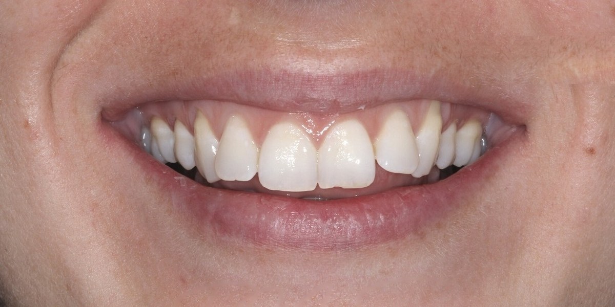 Before Active Aligners treatment, smile, crowded, treated by Dr Marc Sher
