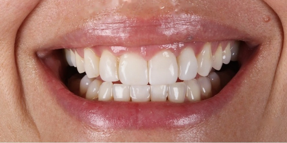 After Active Aligners treatment, smile, treated by Dr Marc Sher