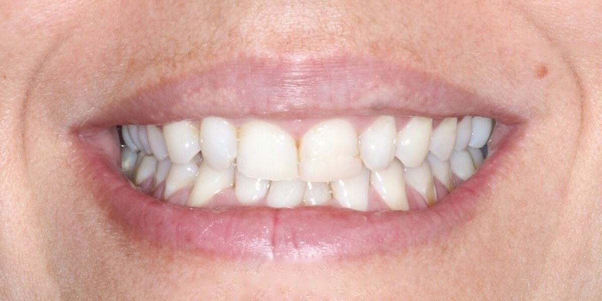 Before Active Aligners treatment, smile, crowded and overbite, treated by Dr Marc Sher