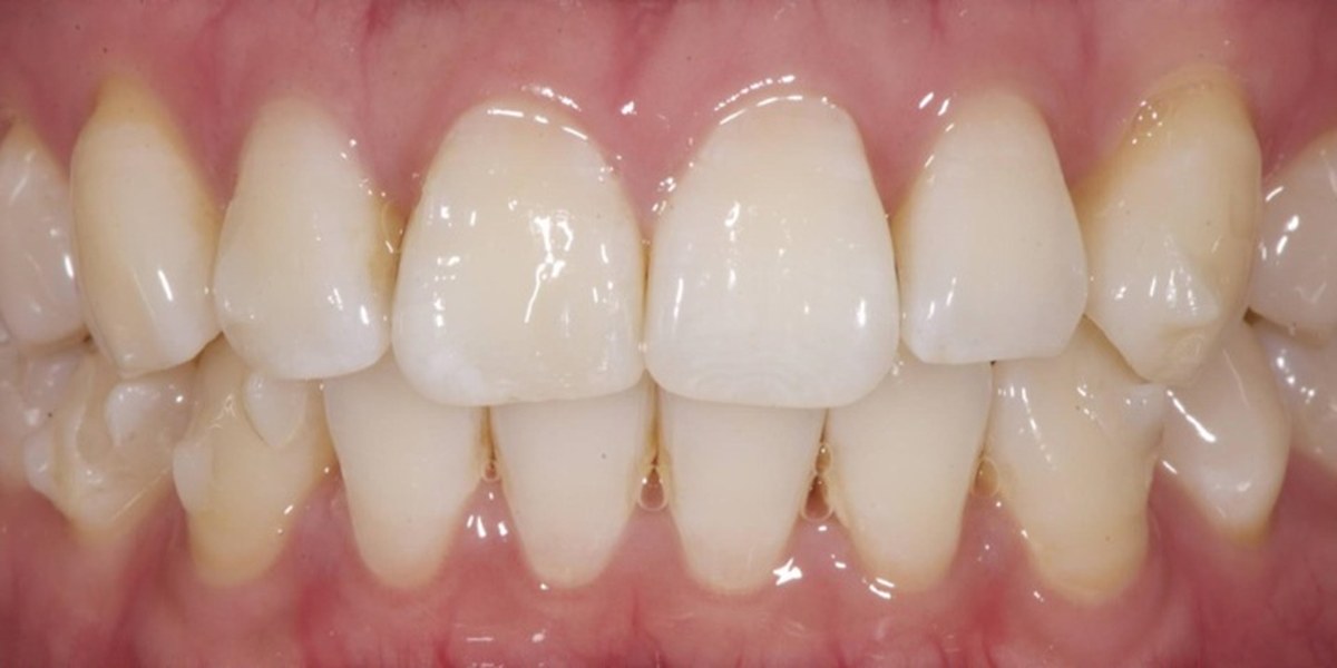 After Active Aligners treatment, front view, treated by Dr Marc Sher