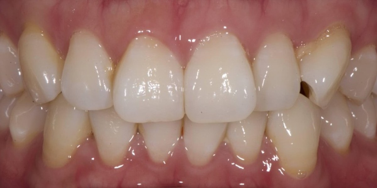 Before Active Aligners treatment, front view, crowded, treated by Dr Marc Sher