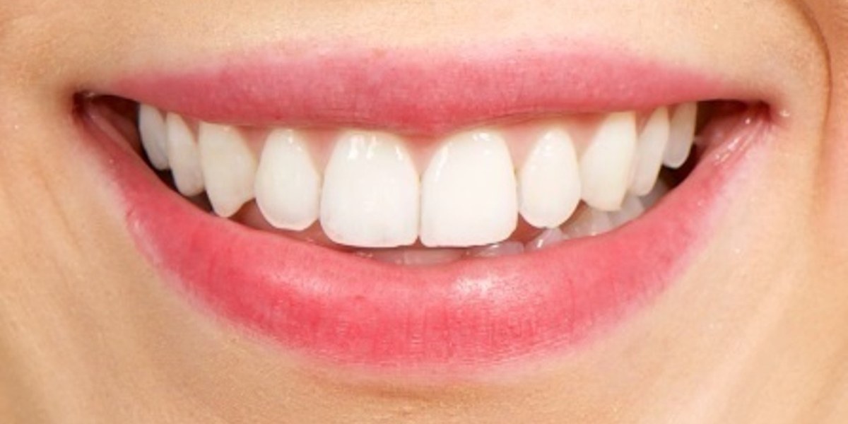 After Active Aligners treatment, smile, treated by Dr Marc Sher