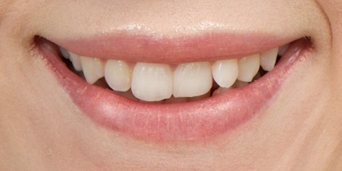 Before Active Aligners treatment, smile, crowded, treated by Dr Marc Sher