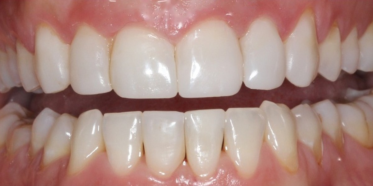 After Active Aligners treatment, front view, treated by Dr Marc Sher
