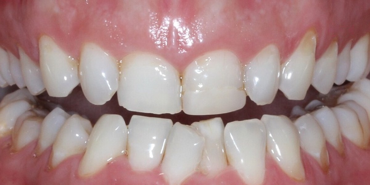 Before Active Aligners treatment, front view, crowded and overbite, treated by Dr Marc Sher