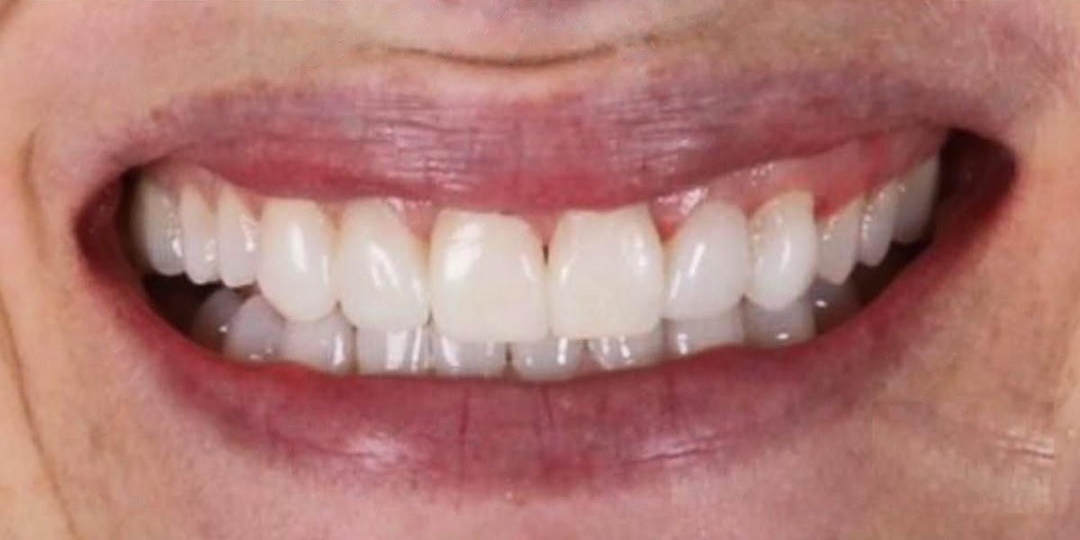 After Active Aligners treatment, smile, treated by Dr Marc Sher