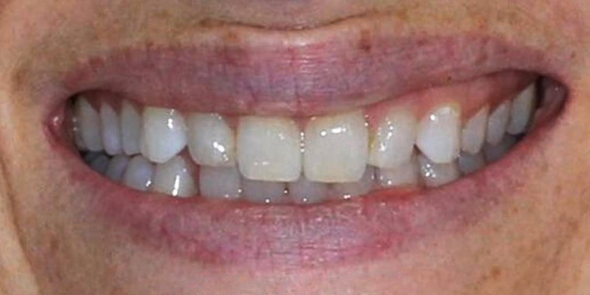 Before Active Aligners treatment, smile, crowded, treated by Dr Marc Sher