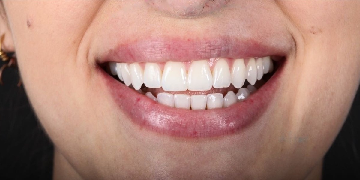 After Active Aligners treatment, smile, treated by Dr Marc Sher