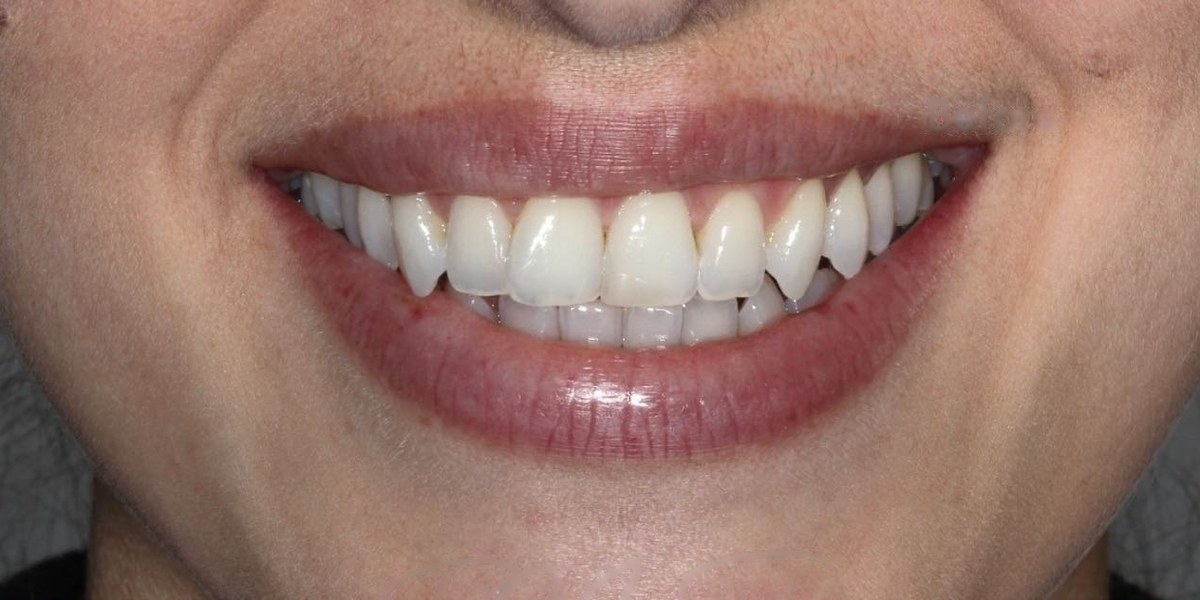 Before Active Aligners treatment, smile, crowded, treated by Dr Marc Sher