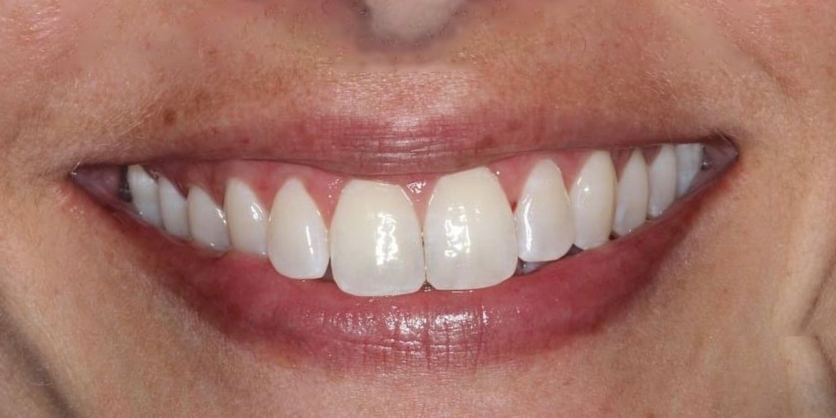 After Active Aligners treatment, smile, treated by Dr Marc Sher