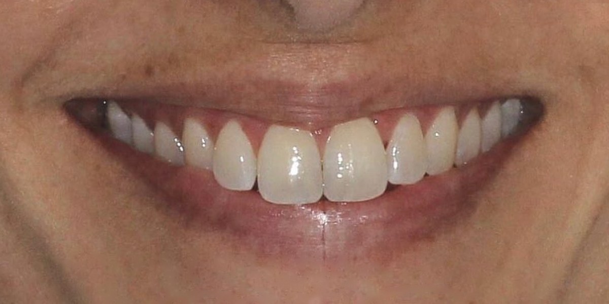 Before Active Aligners treatment, smile, crowded, treated by Dr Marc Sher