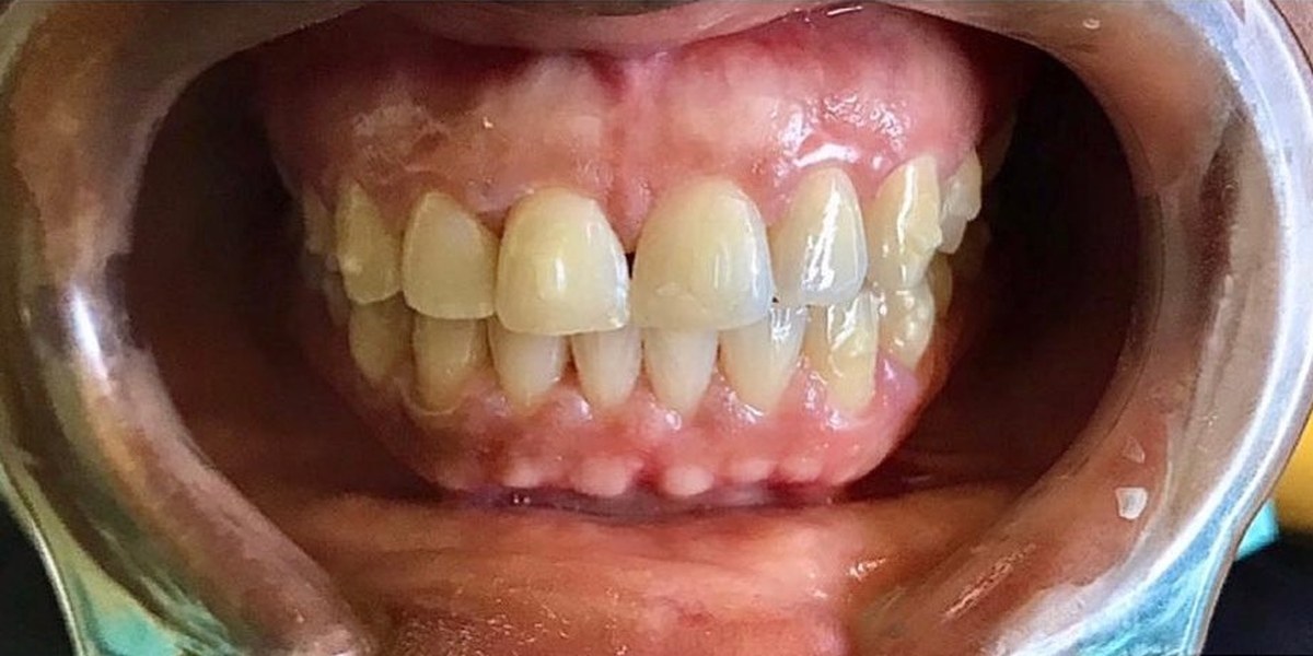 After Active Aligners treatment, front view, treated by Dr Nazrana Vally