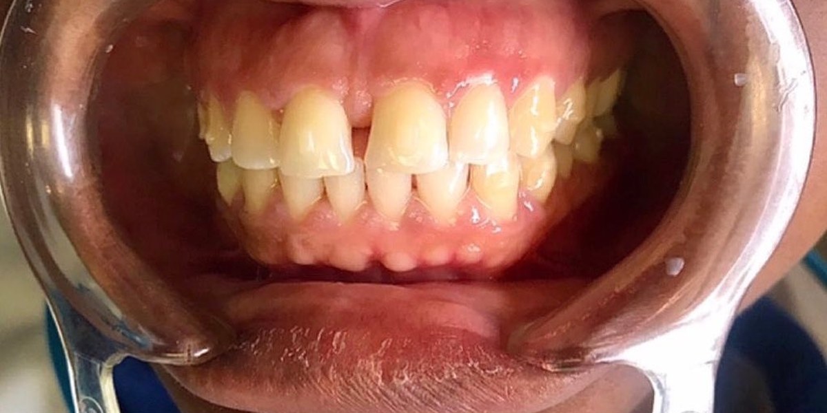 Before Active Aligners treatment, front view, gaps, treated by Dr Nazrana Vally