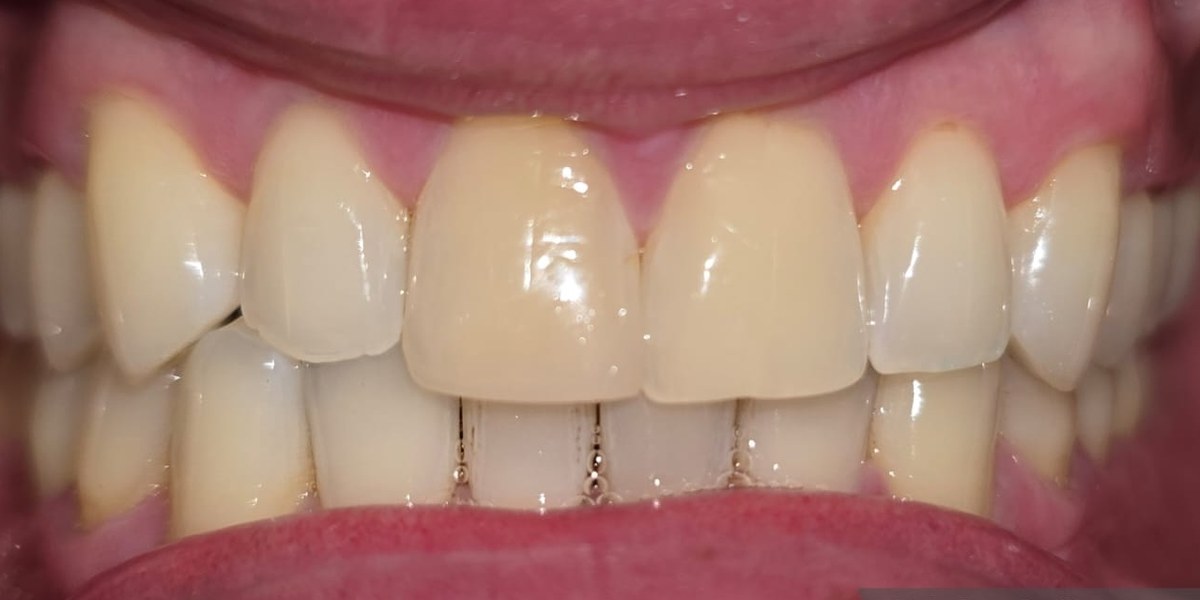 After Active Aligners treatment, front view, treated by Dr Linique van Deventer