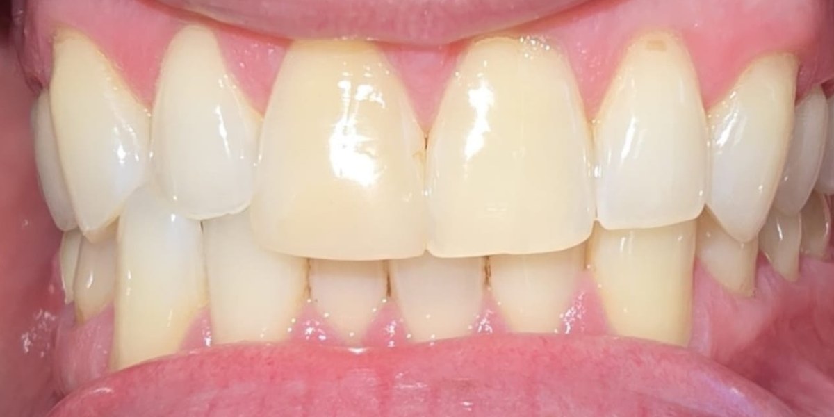 Before Active Aligners treatment, front view, crowded, treated by Dr Linique van Deventer