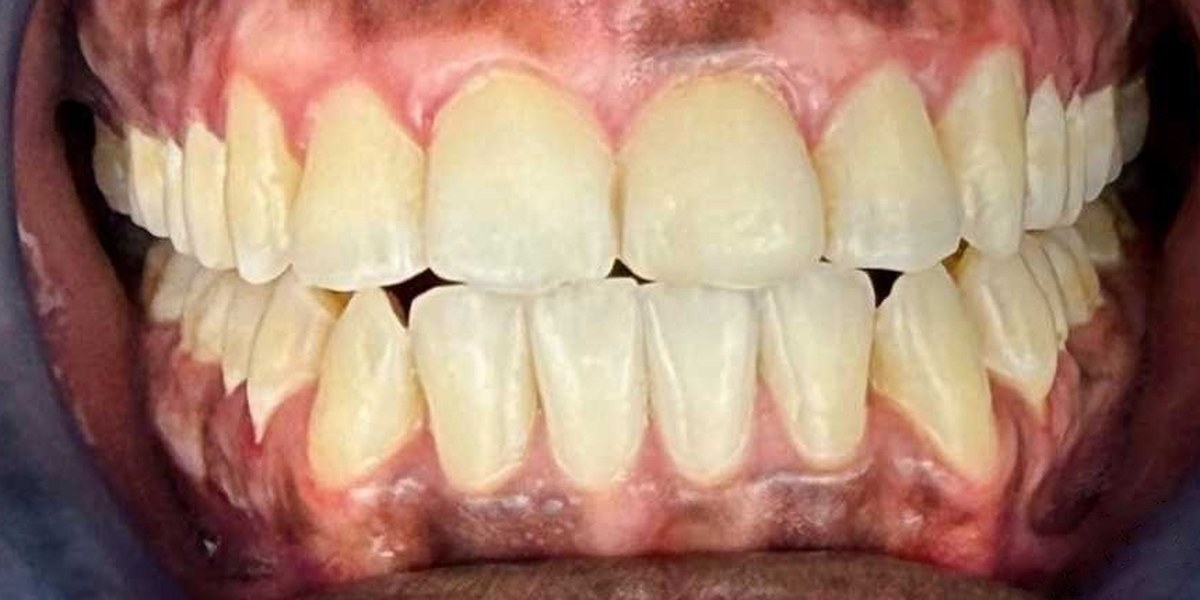 After Active Aligners treatment, front view, treated by Dr Nikita Morar