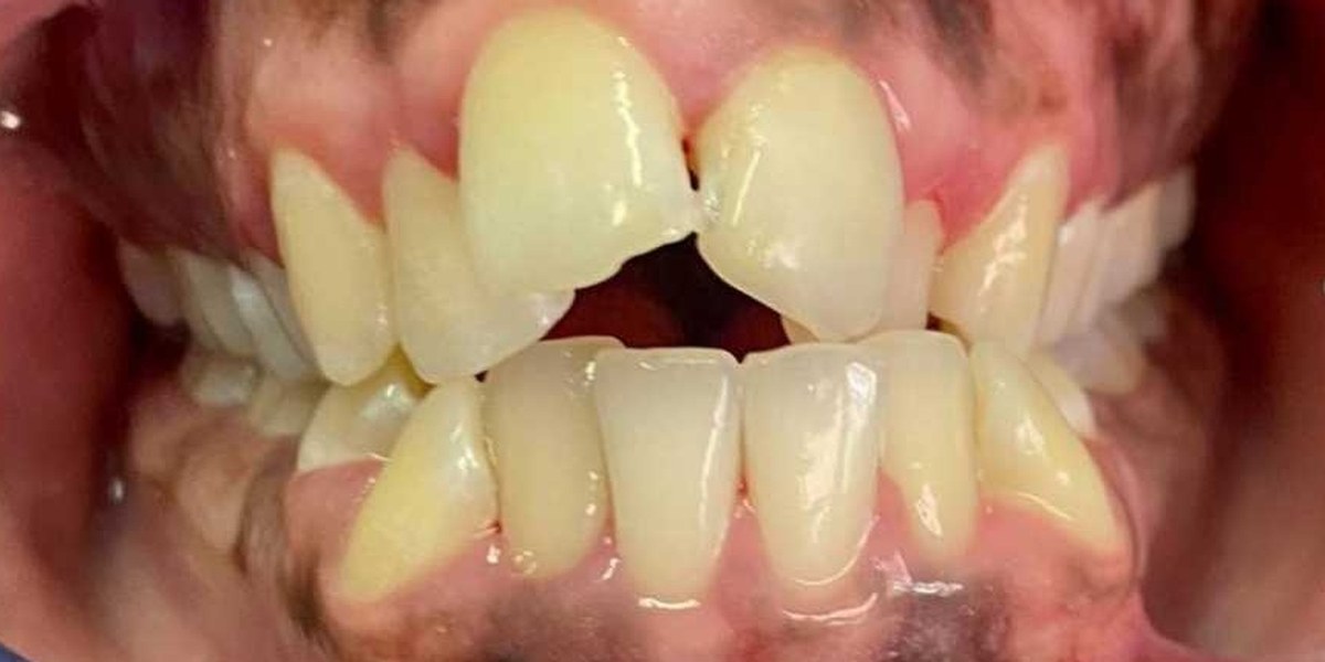 Before Active Aligners treatment, front view, crowded, treated by Dr Nikita Morar