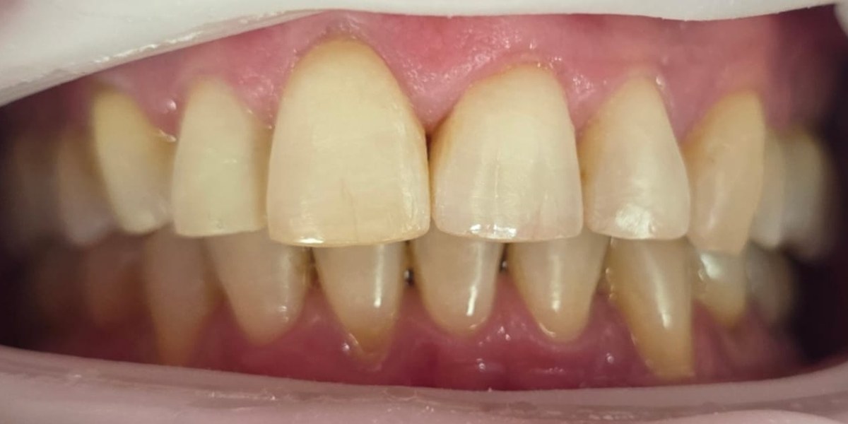 After Active Aligners treatment, front view, treated by Dr Jessica Summerscales
