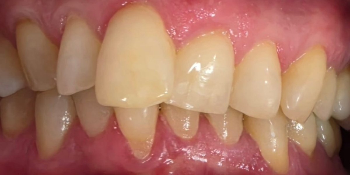 Before Active Aligners treatment, front view, crowded, treated by Dr Jessica Summerscales