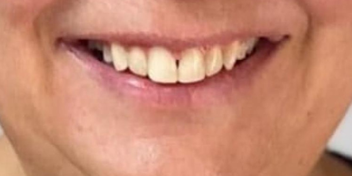 After Active Aligners treatment, smile, treated by Dr Owen Rawlins