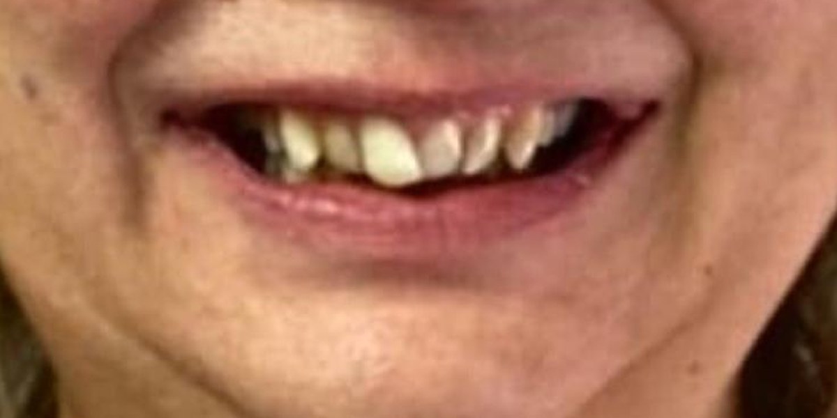 Before Active Aligners treatment, smile, crowded, treated by Dr Owen Rawlins