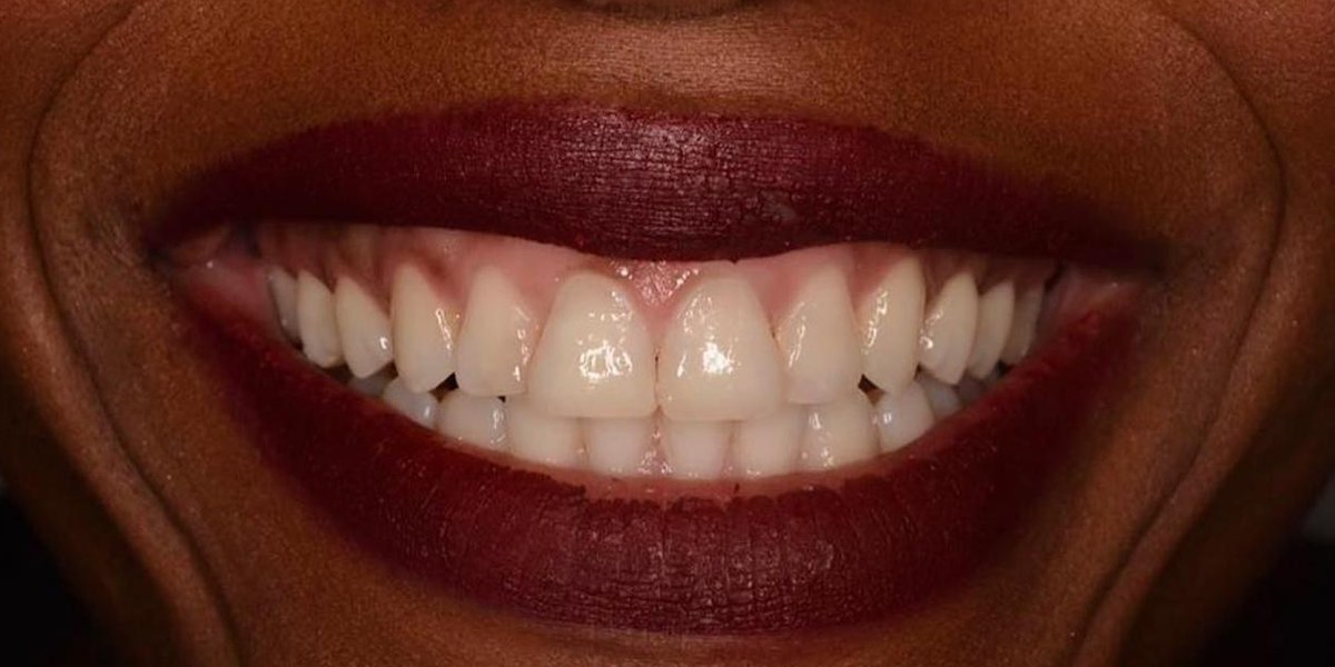 After Active Aligners treatment, smile, treated by Dr Hannes Scheepers