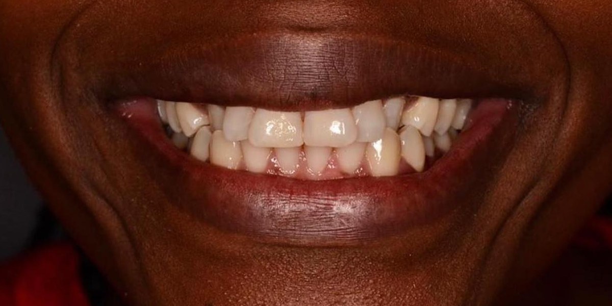 Before Active Aligners treatment, smile, crowded, treated by Dr Hannes Scheepers