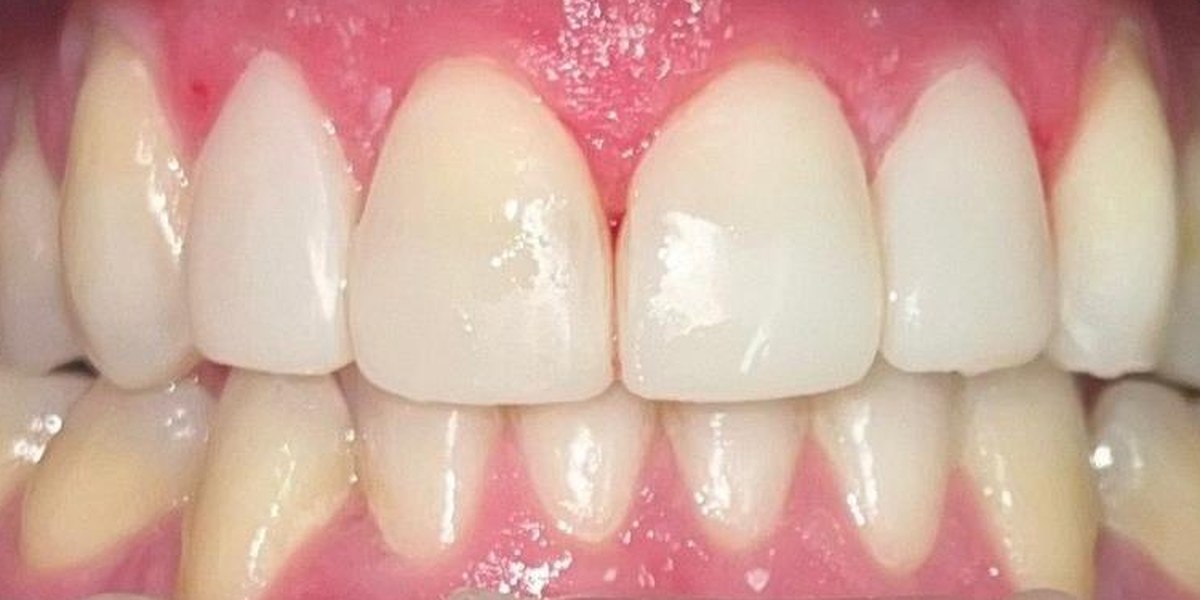 After Active Aligners treatment, front view, treated by Dr Suzanne van der Linden