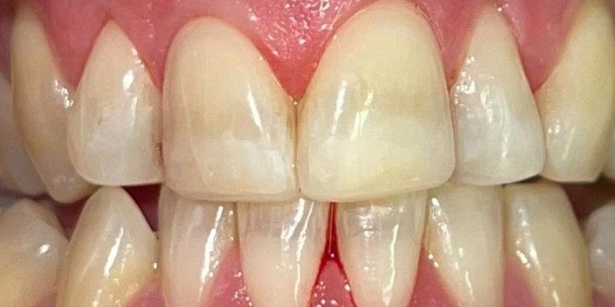 Before Active Aligners treatment, front view, crowded, treated by Dr Suzanne van der Linden