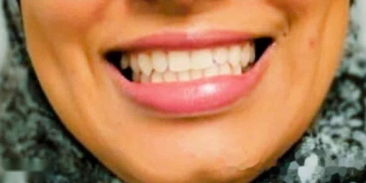 After Active Aligners treatment, smile, treated by Dr Andrea Jacobs