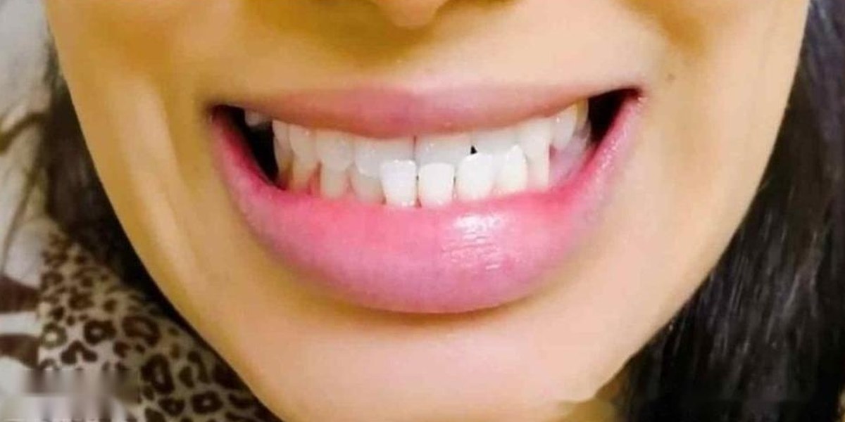 Before Active Aligners treatment, smile, crossbite, treated by Dr Andrea Jacobs