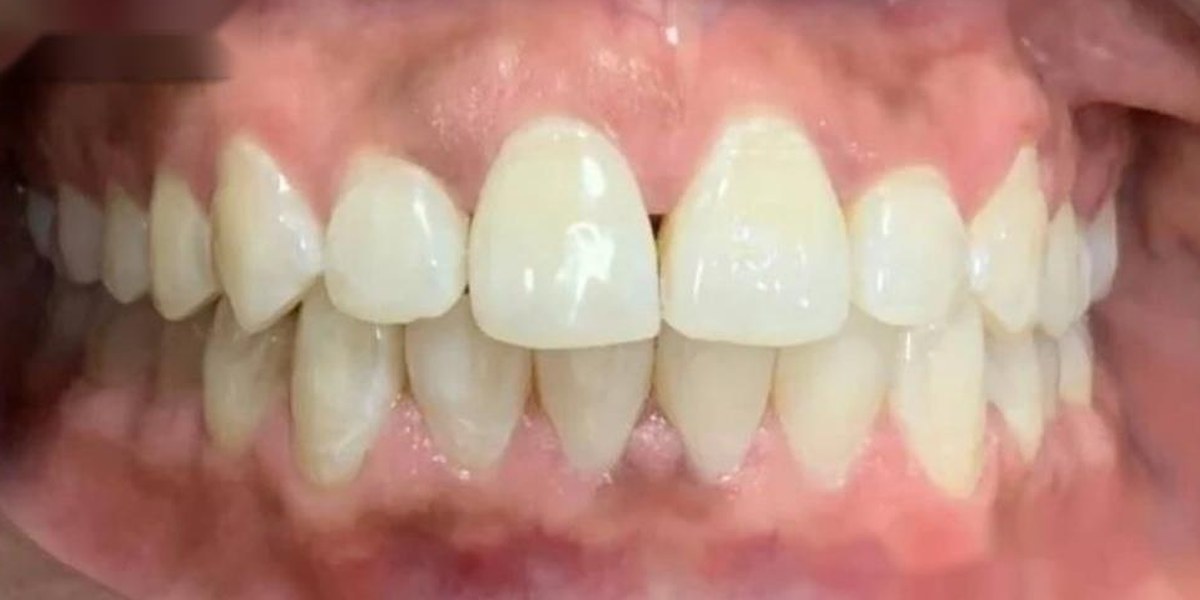 After Active Aligners treatment, front view, treated by Dr Bonolo Mannathoko