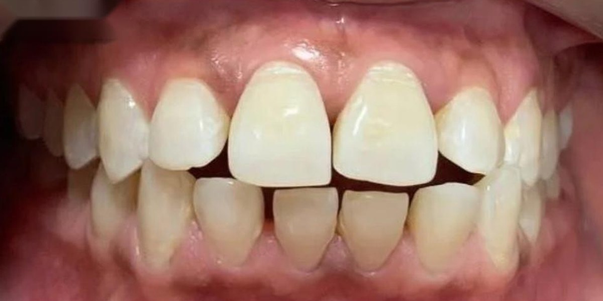 Before Active Aligners treatment, front view, gaps and open bite, treated by Dr Bonolo Mannathoko