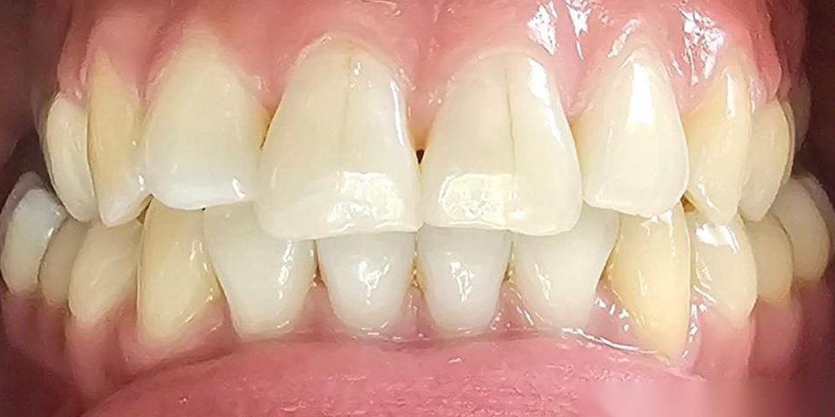 After Active Aligners treatment, front view, treated by Dr Linique van Deventer