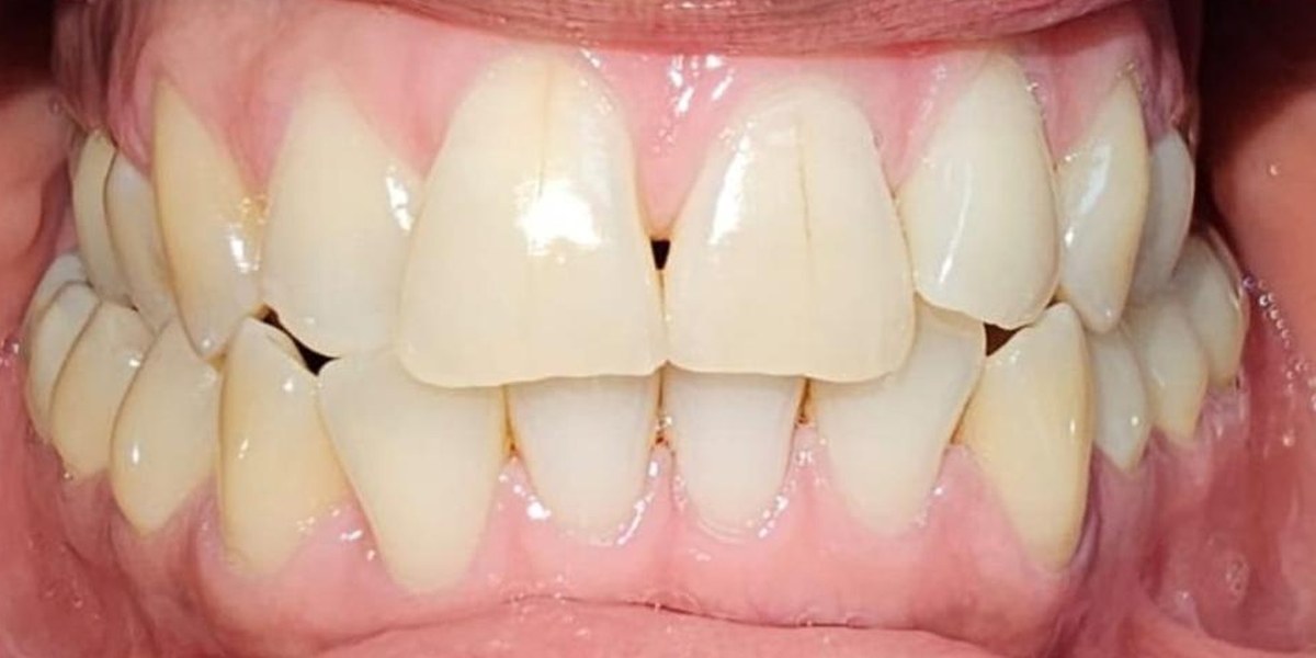 Before Active Aligners treatment, front view, crowded and crossbite, treated by Dr Linique van Deventer