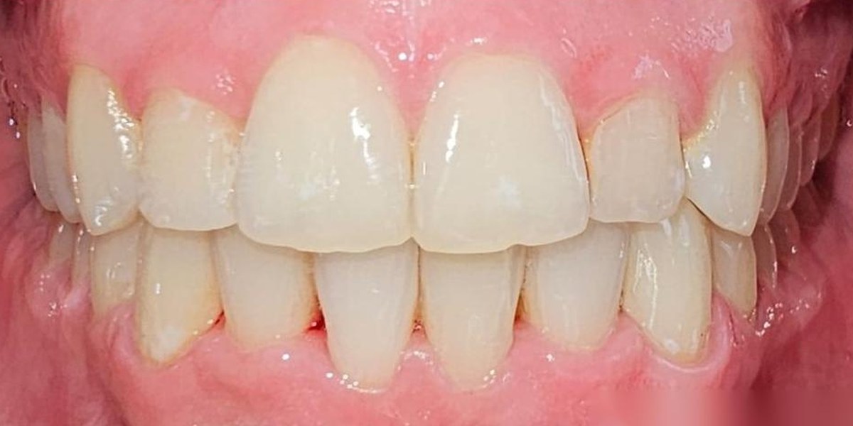 After Active Aligners treatment, front view, treated by Dr Linique van Deventer