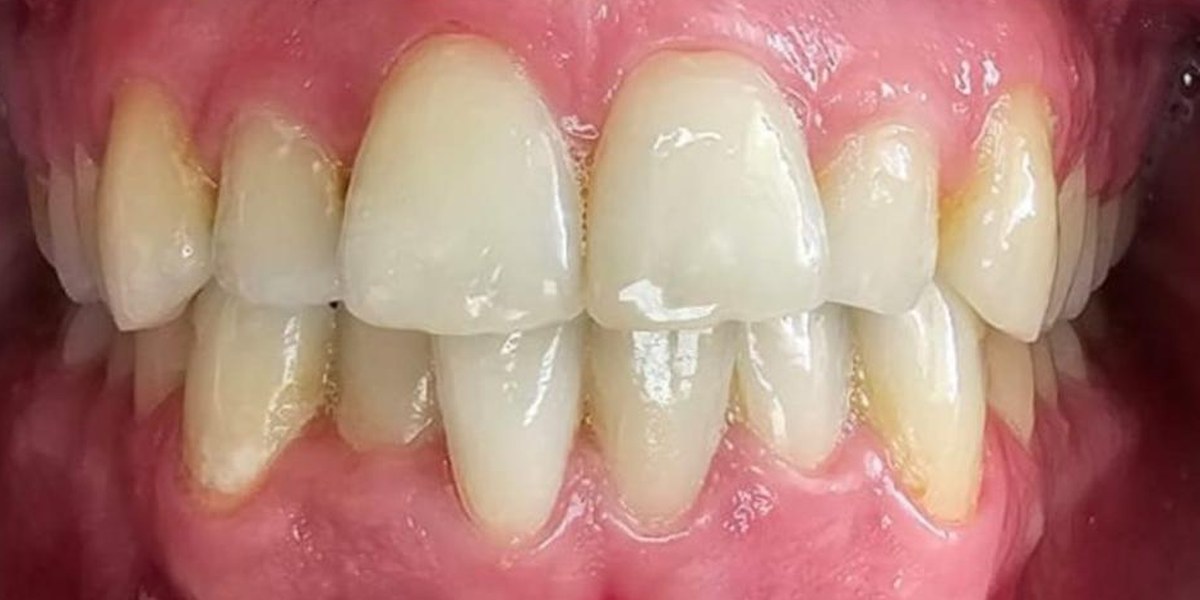 Before Active Aligners treatment, front view, crowded, treated by Dr Linique van Deventer