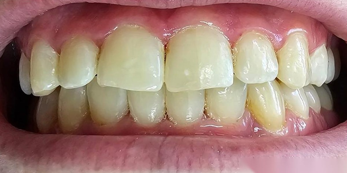 After Active Aligners treatment, front view, treated by Dr Linique van Deventer