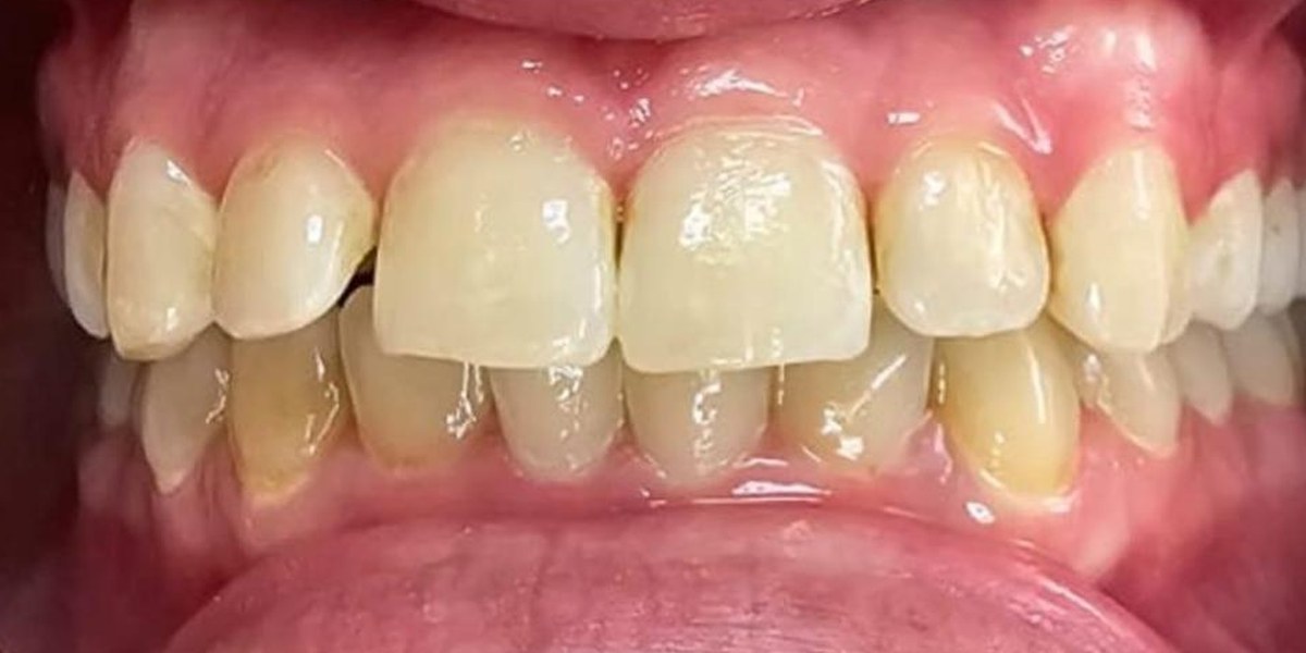 Before Active Aligners treatment, front view, overbite, treated by Dr Linique van Deventer