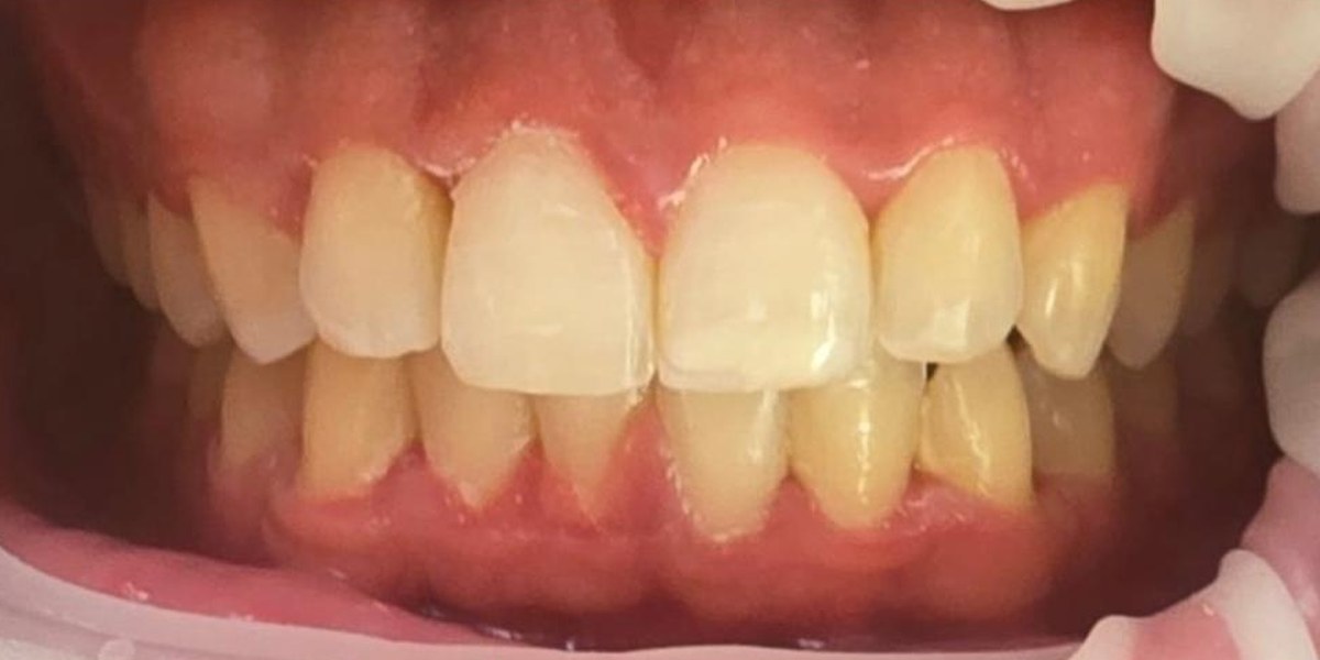 After Active Aligners treatment, front view, treated by Dr Jessica Summerscales