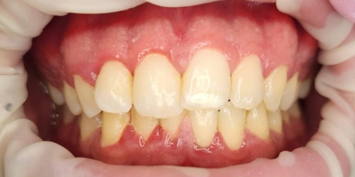 Before Active Aligners treatment, front view, crowded and overbite, treated by Dr Jessica Summerscales