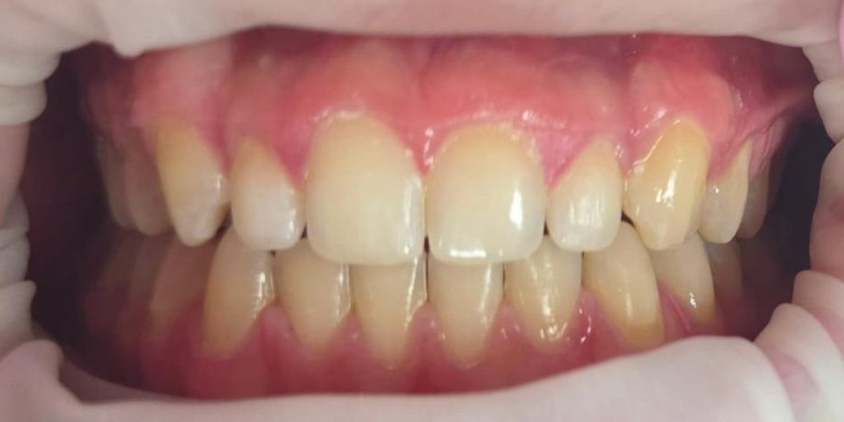 After Active Aligners treatment, front view, treated by Dr Jessica Summerscales