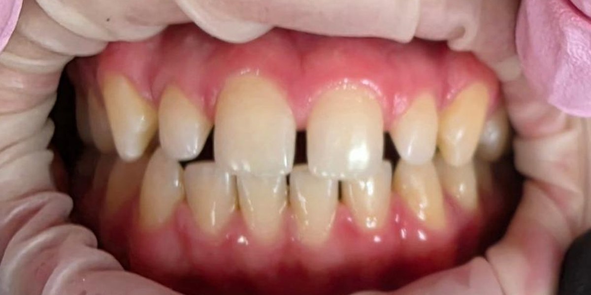 Before Active Aligners treatment, front view, gaps, treated by Dr Jessica Summerscales