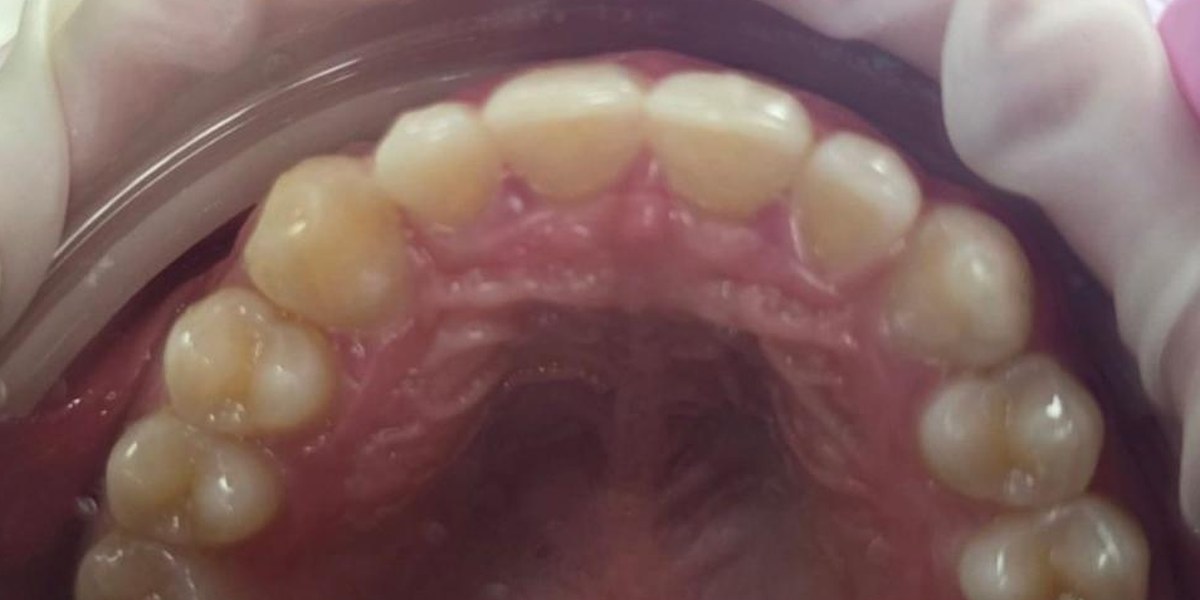After Active Aligners treatment, upper teeth from above, treated by Dr Jessica Summerscales