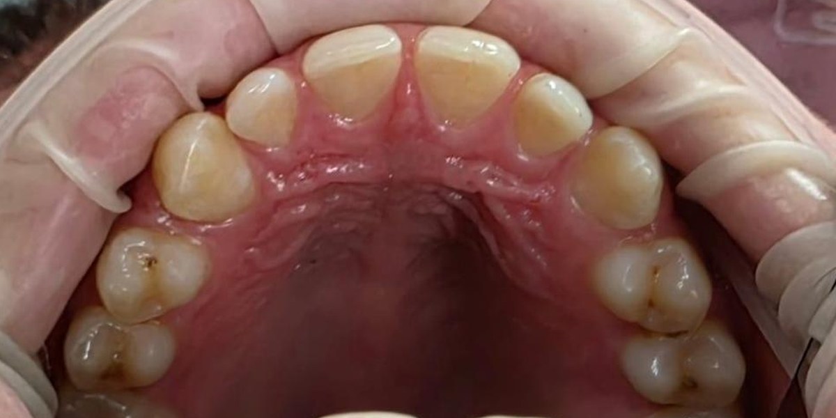 Before Active Aligners treatment, upper teeth from above, gaps, treated by Dr Jessica Summerscales
