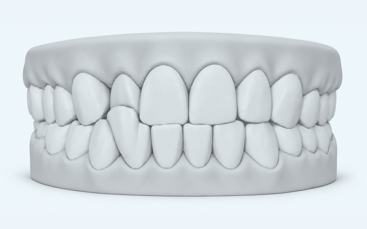Illustration of a crossbite