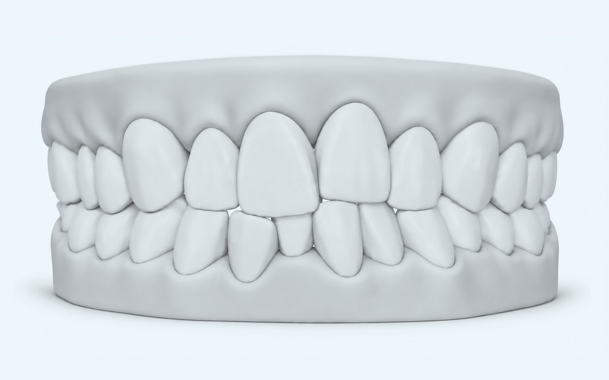 Illustration of crowded teeth