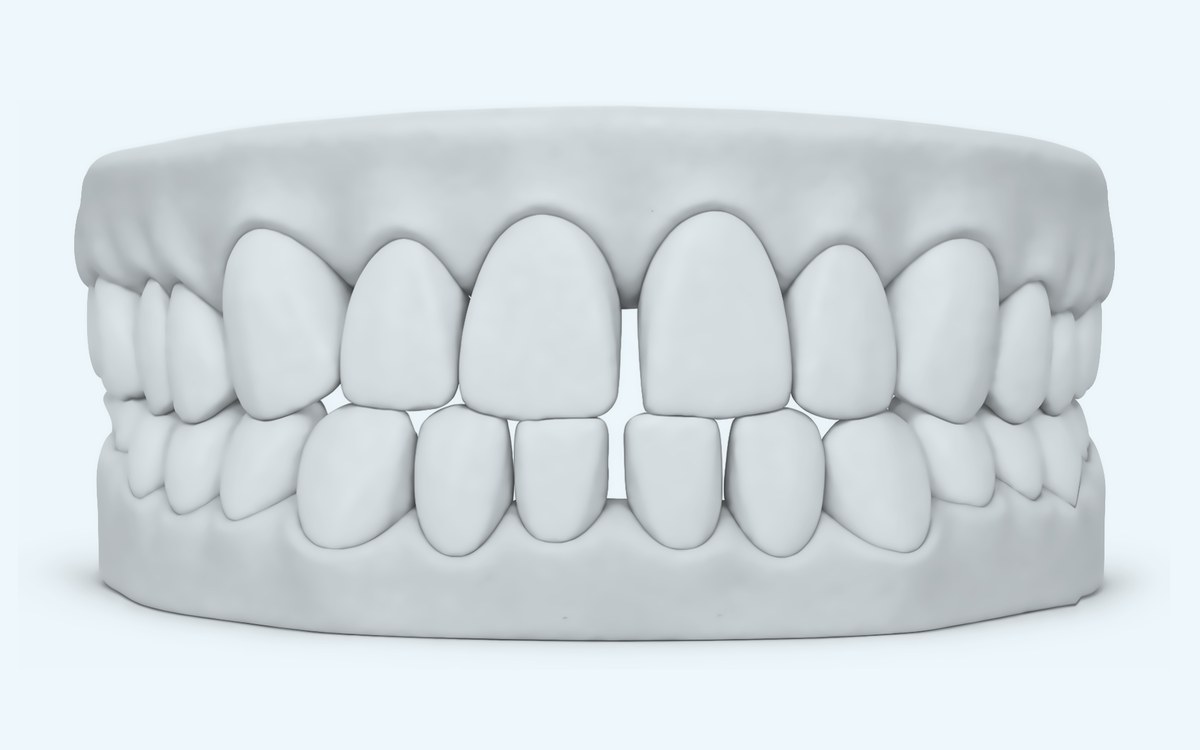 Illustration of gaps between teeth